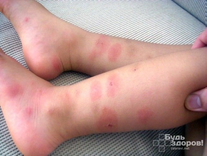 Аллергия у детей после укусов постельных клопов