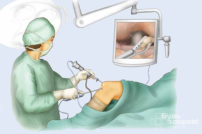 Артроскопия - операция на мениске