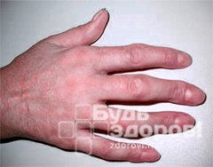 Деформация пальца рука