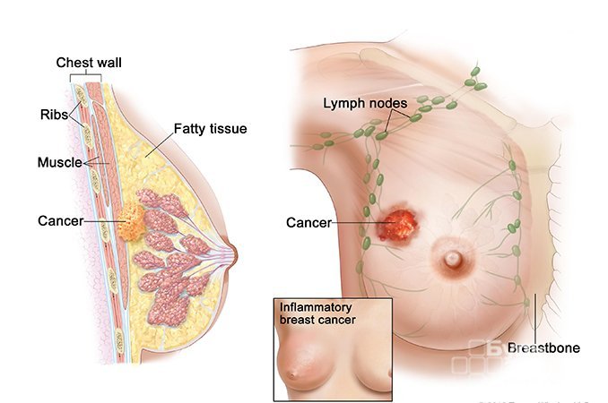 Рак молочной железы - злокачественная опухоль