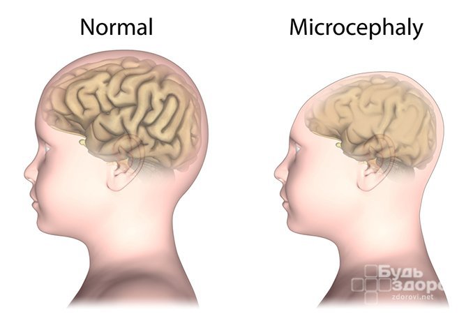 Микроцефалия характеризуется уменьшенной окружностью черепной коробки