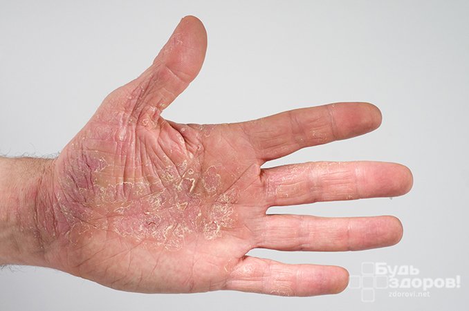 Нейродермит — хроническое воспаление кожи