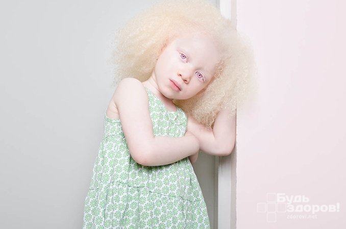 Альбинизм - недостаточная выработка пигмента меланина