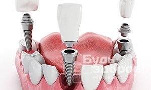 Имплантация зубов: особенности подготовки и преимущества
