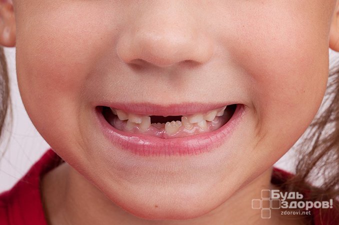 Адентия - полное или частичное отсутствие зубов и их зачатков