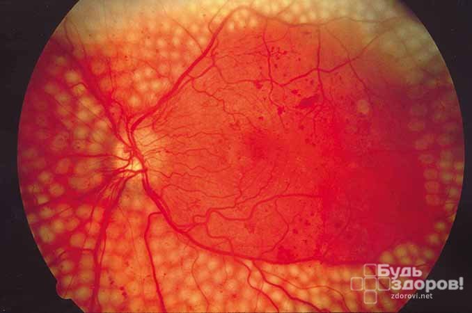 Ретинопатия — невоспалительное повреждение кровеносных сосудов, снабжающих сетчатку глазного яблока