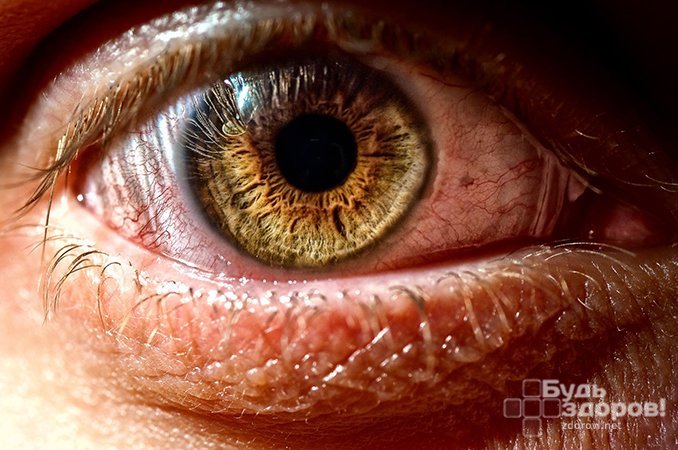 Синдром сухого глаза характеризуется нарушением качества слезной пленки