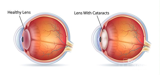 Катаракта - расстройство зрения