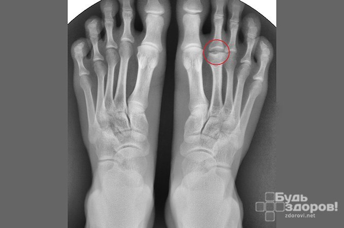 Остеохондропатия стопы на рентегологическом снимке