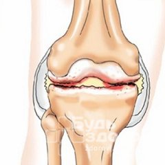 Реактивный артрит - воспалительное заболевание суставов и сухожильной ткани