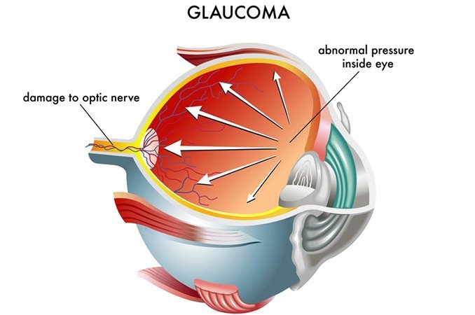 Тяжелое заболевание органа зрения - глаукома
