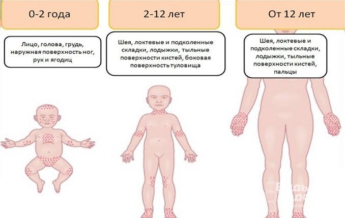 Симптомы атопического дерматита у детей разного возраста