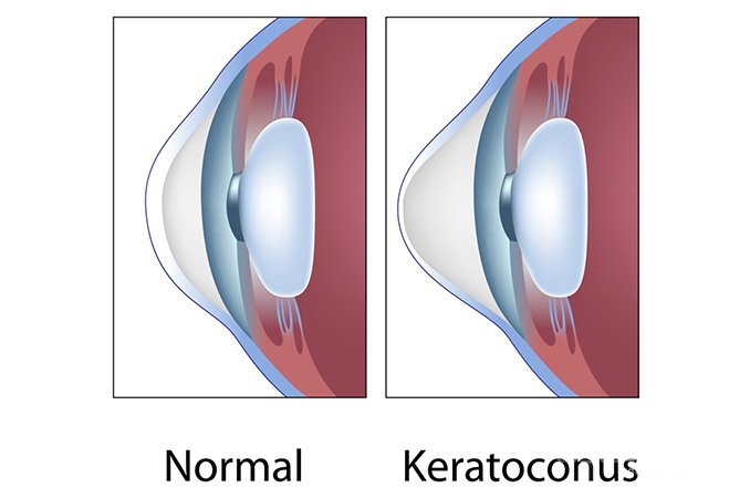 Кератоконус — истончение и выпячивание роговицы глаза