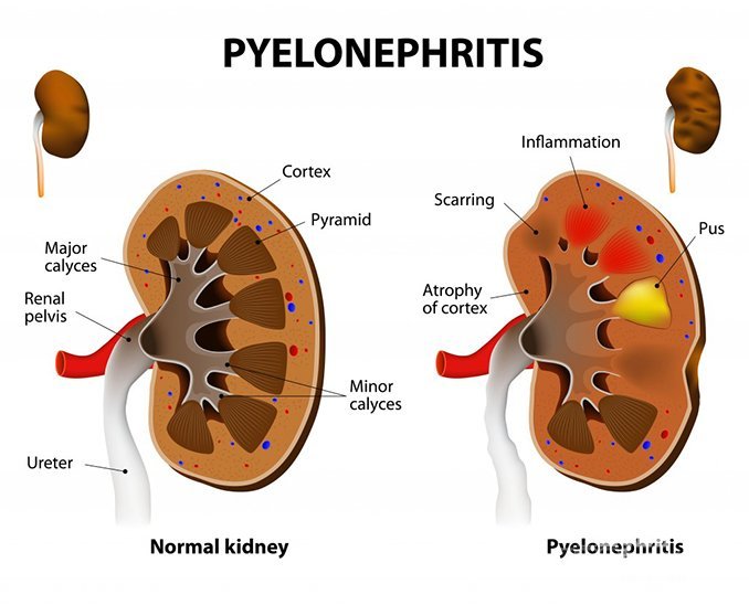 Острый пиелонефрит - инфекционно-воспалительное заболевание почек