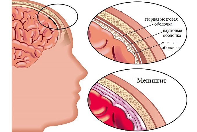 Гнойный менингит у взрослых и детей, симптомы вторичного гнойного ...