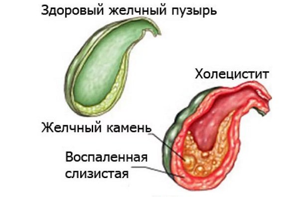 Диета для калькулезный холецистит