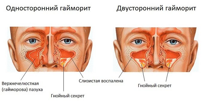 Острый гайморит карта вызова