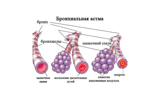 Бронхиальная астма это. Бронхиальная астма. Бронхи при бронхиальной астме. Бронхи при астме. Гладкие мышцы бронхов.