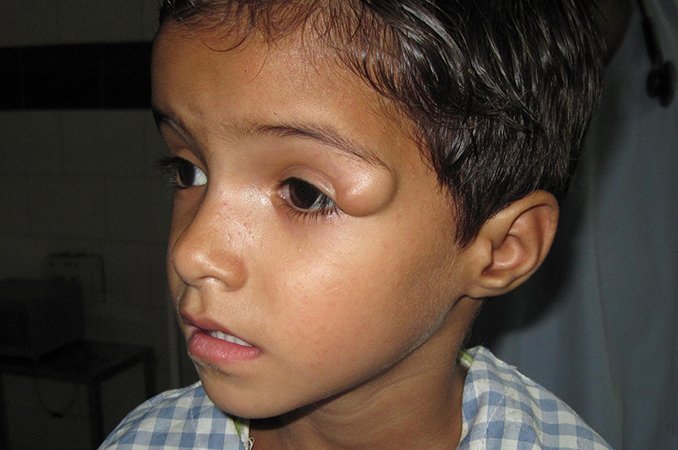 Дермоидная киста - причины, лечение, удаление