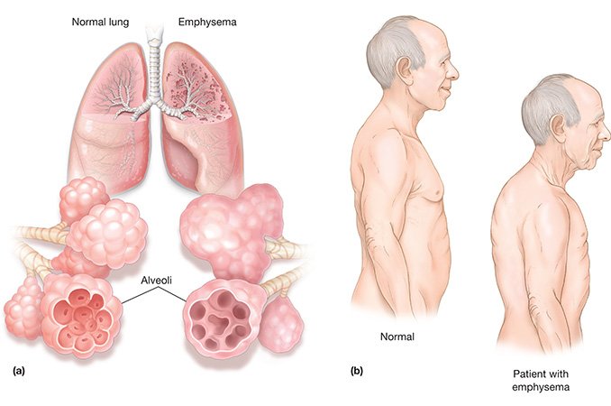 Эмфизема легких - лечение, симптомы, прогноз