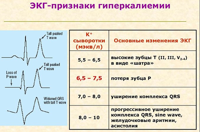 Гиперкалиемия - симптомы, причины, лечение
