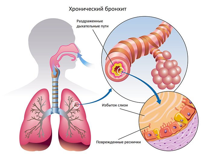 Воспаление стенки бронхов