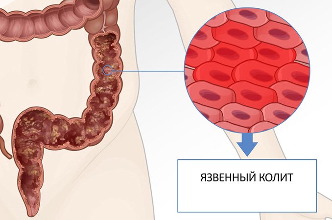 Язвенный колит - лечение, симптомы, диета