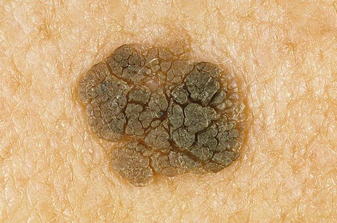 Кератома - виды, лечение, народные средства
