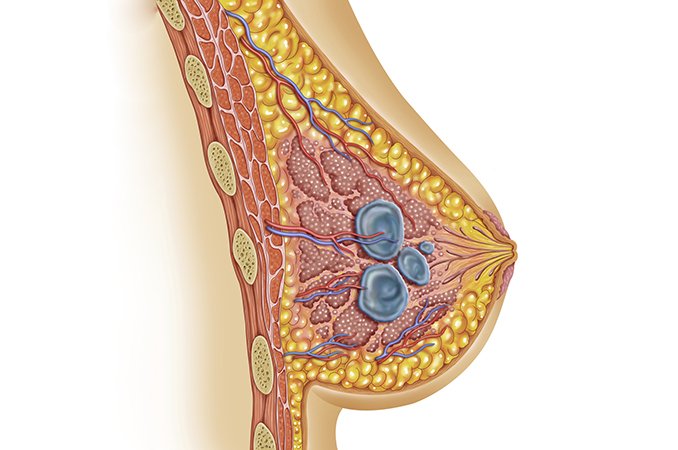 Кисты в грудных железах. Субареолярная киста молочной железы. Инфицированная киста молочной железы. Ацинозные кисты молочной железы.