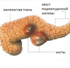 Фото больной поджелудочной железы