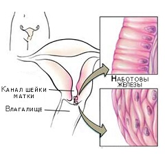 Наботовы кисты шейки матки что это такое Наботовы кисты шейки матки что это такое