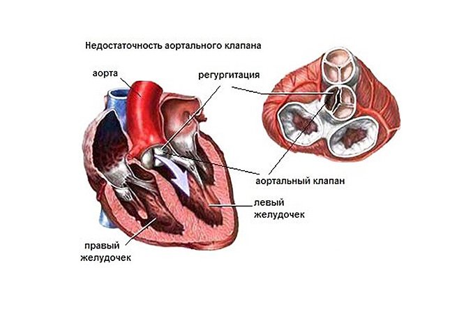 Двустворчатый аортальный клапан классификация