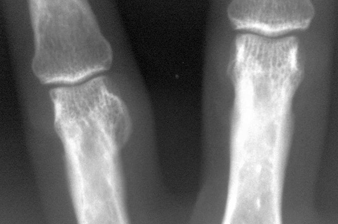 Остеома кости - лечение, симптомы, причины