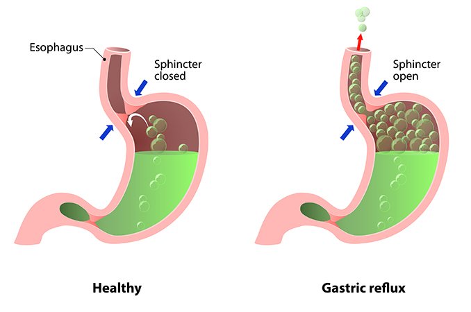 Рефлюкс – лечение, виды, причины, симптомы, осложнения