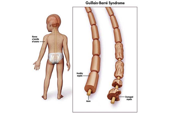 Синдром Гийена-Барре – причины, симптомы, лечение