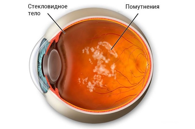 Деструкция стекловидного тела