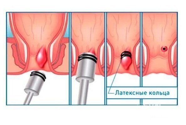 Легирование – один из способов лечения геморроя у женщин