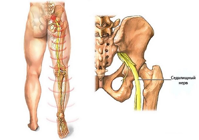 Защемление седалищного нерва: симптомы и лечение