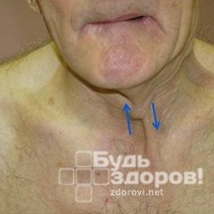 Бульбарный синдром - патология черепных нервов