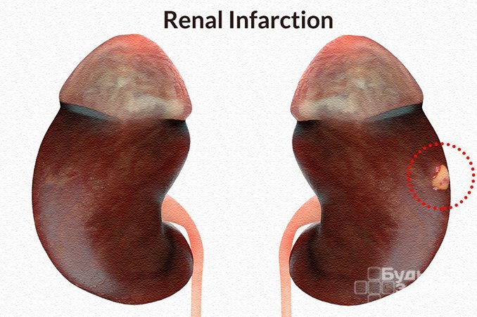Инфаркт почки - некроз тканей
