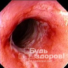 Неспецифический язвенный колит - язвенно-воспалительное поражение слизистой оболочки прямой и ободочной кишек