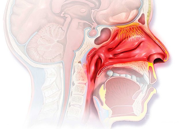 Ринит - воспаление слизистой оболочки носа