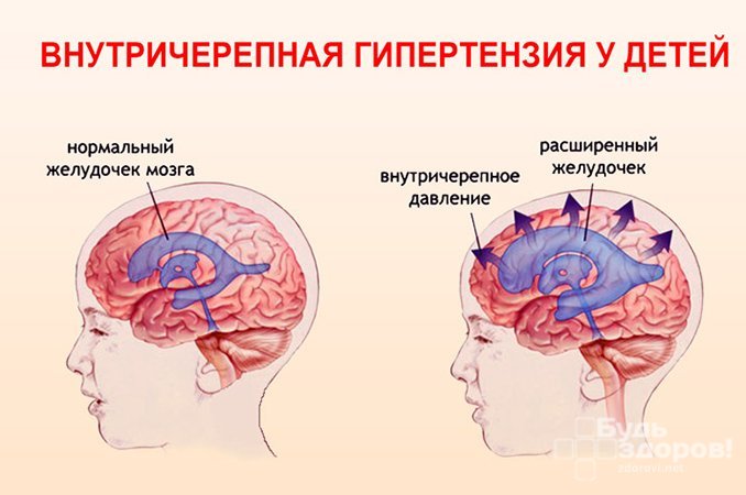 Внутричерепная гипертензия - повышение давления в полости черепа